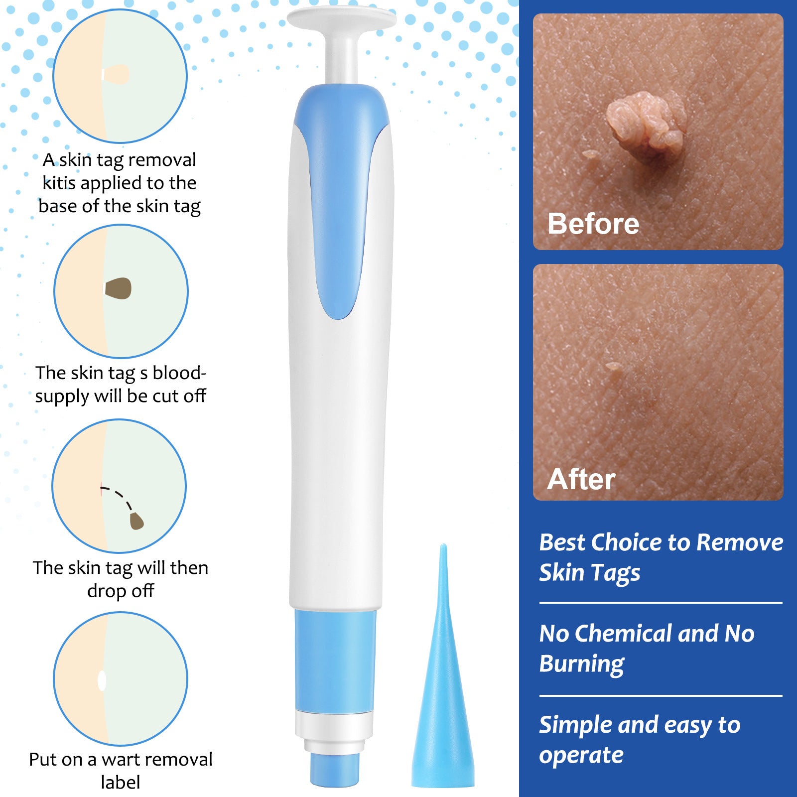 At-Home Skin Tag Remover