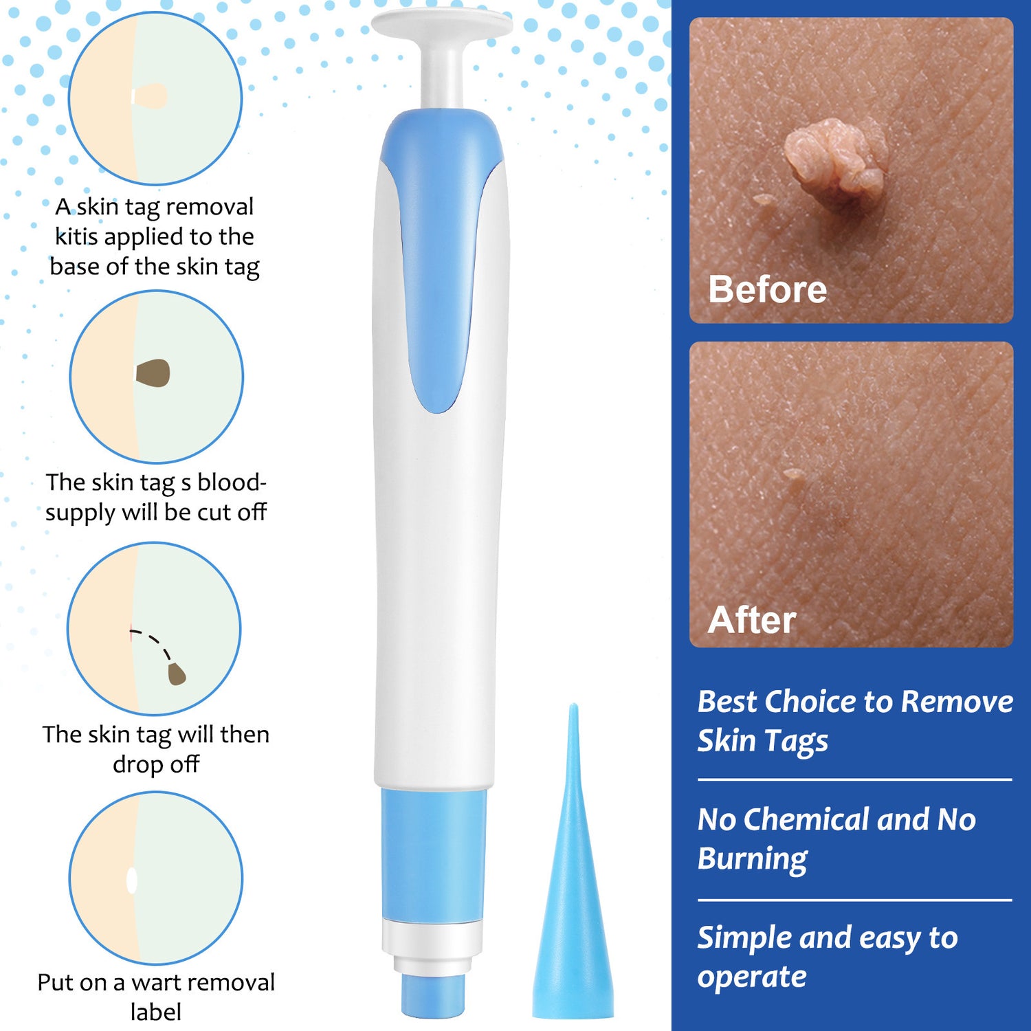 At-Home Skin Tag Remover